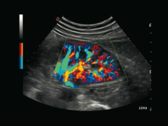 Ecocolor-Doppler